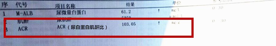 臨床目前最常用尿蛋白肌酐比來反應尿微量白蛋白的水平